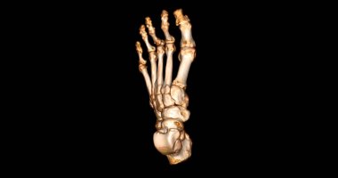 CT-SCANNER 'ın ayak hastalıklarını teşhis etmek için 3D tarama .