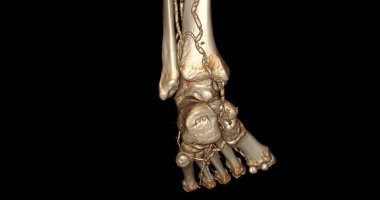 CT-SCANNER 'ın ayak hastalıklarını teşhis etmek için 3D tarama .