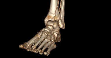 CT-SCANNER 'ın ayak hastalıklarını teşhis etmek için 3D tarama .