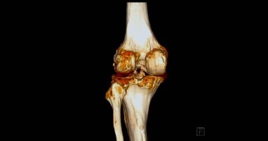 Tomografi taramasında kırık kaval kemiği ve fibula kemiği 3D görüntüleme.