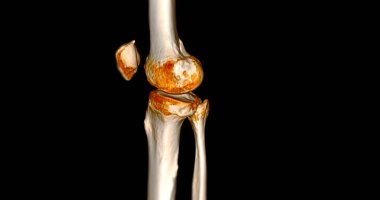 Tomografi taramasında kırık kaval kemiği ve fibula kemiği 3D görüntüleme.