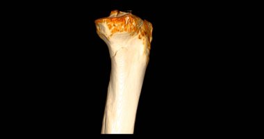 Tomografi taramasında kırık kaval kemiği ve fibula kemiği 3D görüntüleme.
