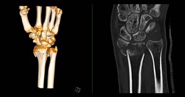 Bilek eklem tomografisi. Bilek eklem ağrısı teşhisi için 3D tarama..