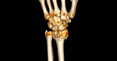 Bilek eklem tomografisi. Bilek eklem ağrısı teşhisi için 3D tarama..