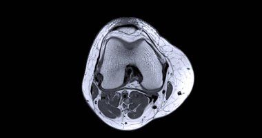 Ön çapraz bağ dokusunda yırtılma veya burkulma tespit etmek için diz eklem c 'nin manyetik rezonans görüntülemesi veya MRI' sı (ACL)