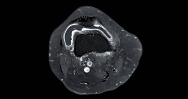 Ön çapraz bağ dokusunda yırtılma veya burkulma tespit etmek için diz eklem c 'nin manyetik rezonans görüntülemesi veya MRI' sı (ACL)
