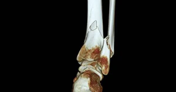 Scan Ankle Joint Rendering Image Showing Fracture Tibia Fibula Bone — Stock Photo, Image