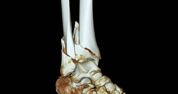 Sken Kotníkového Kloubu Rendering Image Showing Fracture Tibia Fibula Bone — Stock fotografie