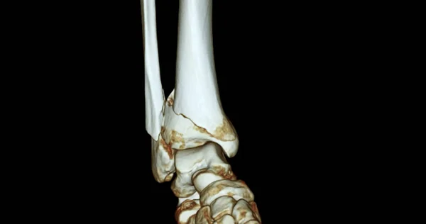 Сканування Гомілковостопного Суглоба Відтворення Зображення Показує Перелом Великогомілкової Кістки Кістки — стокове фото