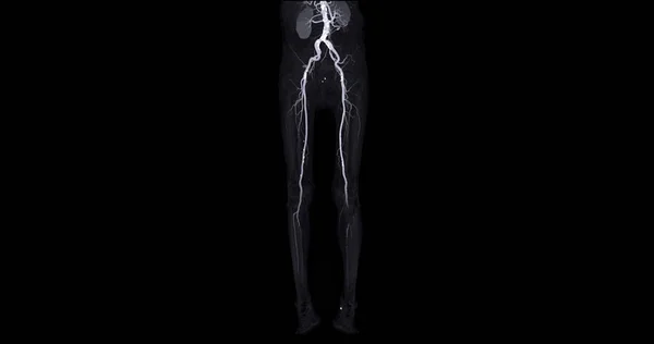 Cta Arteria Femoral Desprende Imagen Arteria Femoral Para Diagnóstico Enfermedad —  Fotos de Stock