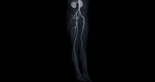 Cta Femoral Artery Run Image Femoral Artery Diagnostic Acute Chronic — Stock Photo, Image