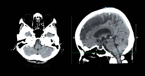 Scan Van Hersenen Sagittale Weergave Voor Diagnose Hersentumor Beroerte Ziekten — Stockfoto