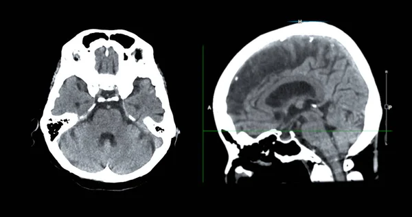 Beyin Tümörü Felç Damar Hastalıkları Için Beyin Sagital Görüşünün Taraması — Stok fotoğraf