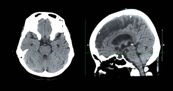 Datortomografi Hjärnan Sagittal För Diagnos Hjärntumör Stroke Sjukdomar Och Kärlsjukdomar — Stockfoto