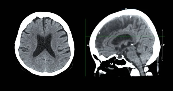 脳腫瘍 脳卒中疾患および血管疾患の診断のための脳血管ビューのCtスキャン — ストック写真