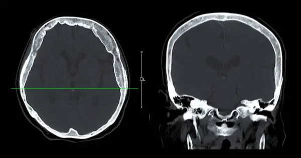 Сагиттального Зрения Мозга Диагностики Опухоли Головного Мозга Инсультных Заболеваний Сосудистых — стоковое фото