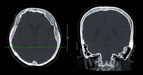 Tomografia Computadorizada Visão Sagital Cérebro Para Diagnóstico Tumor Cerebral Doenças — Fotografia de Stock