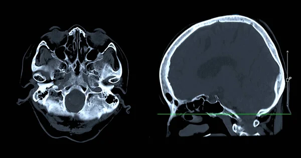 Tomografia Komputerowa Mózgu Kierunku Rozpoznania Guza Mózgu Udaru Mózgu Chorób — Zdjęcie stockowe
