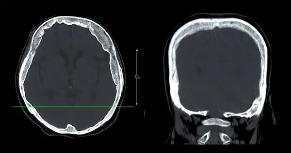 Сканування Зору Сагітального Мозку Діагностики Пухлини Мозку Інсультних Захворювань Судинних — стокове фото
