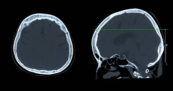 Сканування Зору Сагітального Мозку Діагностики Пухлини Мозку Інсультних Захворювань Судинних — стокове фото