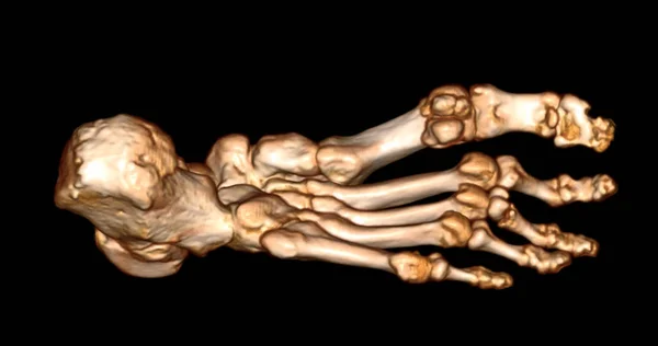 Foot 3D Scan for diagnosis foot diseases by CT-SCANNER .