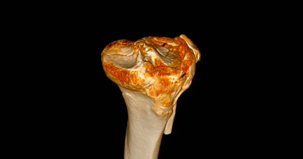 Escaneamento Articulação Joelho Mostrando Fratura Tíbia Osso Fíbula Renderização — Fotografia de Stock