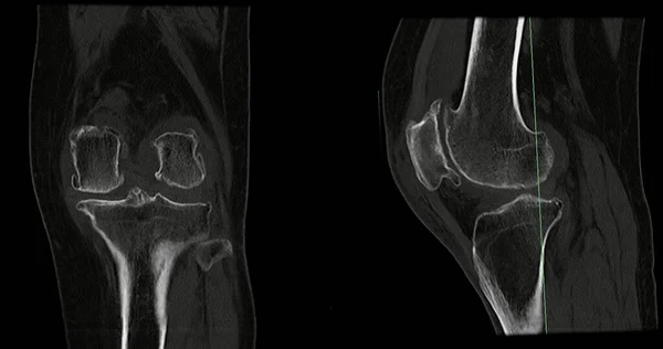 stock image CT Scan of Knee joint for medical background .