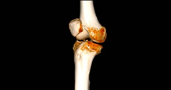 膝关节Ct扫描显示胫骨和腓骨骨折3D表现 — 图库照片