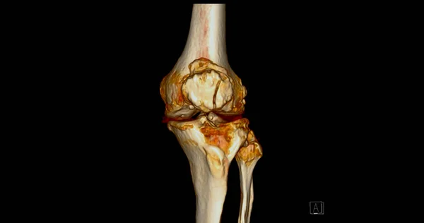 Scan Van Het Kniegewricht Met Fractuur Tibia Fibula Bot Rendering — Stockfoto