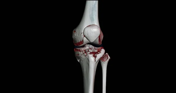 Scan Knee Joint Showing Fracture Tibia Fibula Bone Rendering — Stock Photo, Image