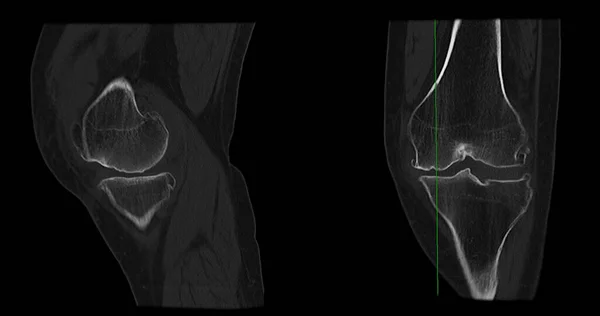 Scan Knee Joint Showing Fracture Tibia Fibula Bone Rendering Stock ...