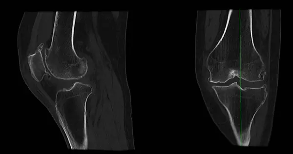 Scan Knee Joint Showing Fracture Tibia Fibula Bone Rendering — Foto ...