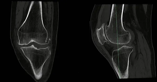 Scan Knee Joint Showing Fracture Tibia Fibula Bone Rendering Stock ...