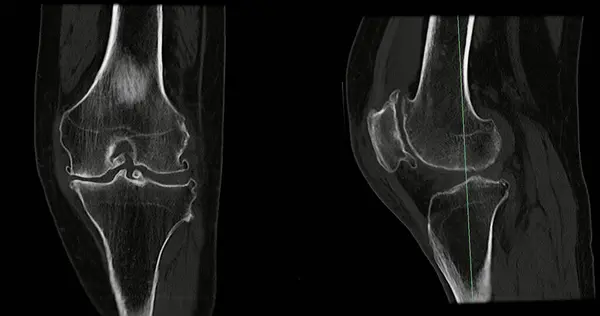 Scan Knee Joint Showing Fracture Tibia Fibula Bone Rendering Stock ...