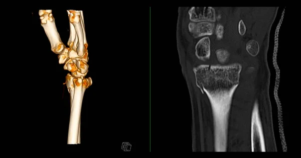 腕关节三维Ct扫描诊断腕关节疼痛 — 图库照片