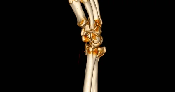 腕关节三维Ct扫描诊断腕关节疼痛 — 图库照片