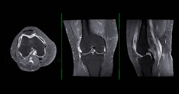 Magnetic Resonance Imaging Mri Knee Joint Detect Tear Sprain Anterior — Stock Photo, Image