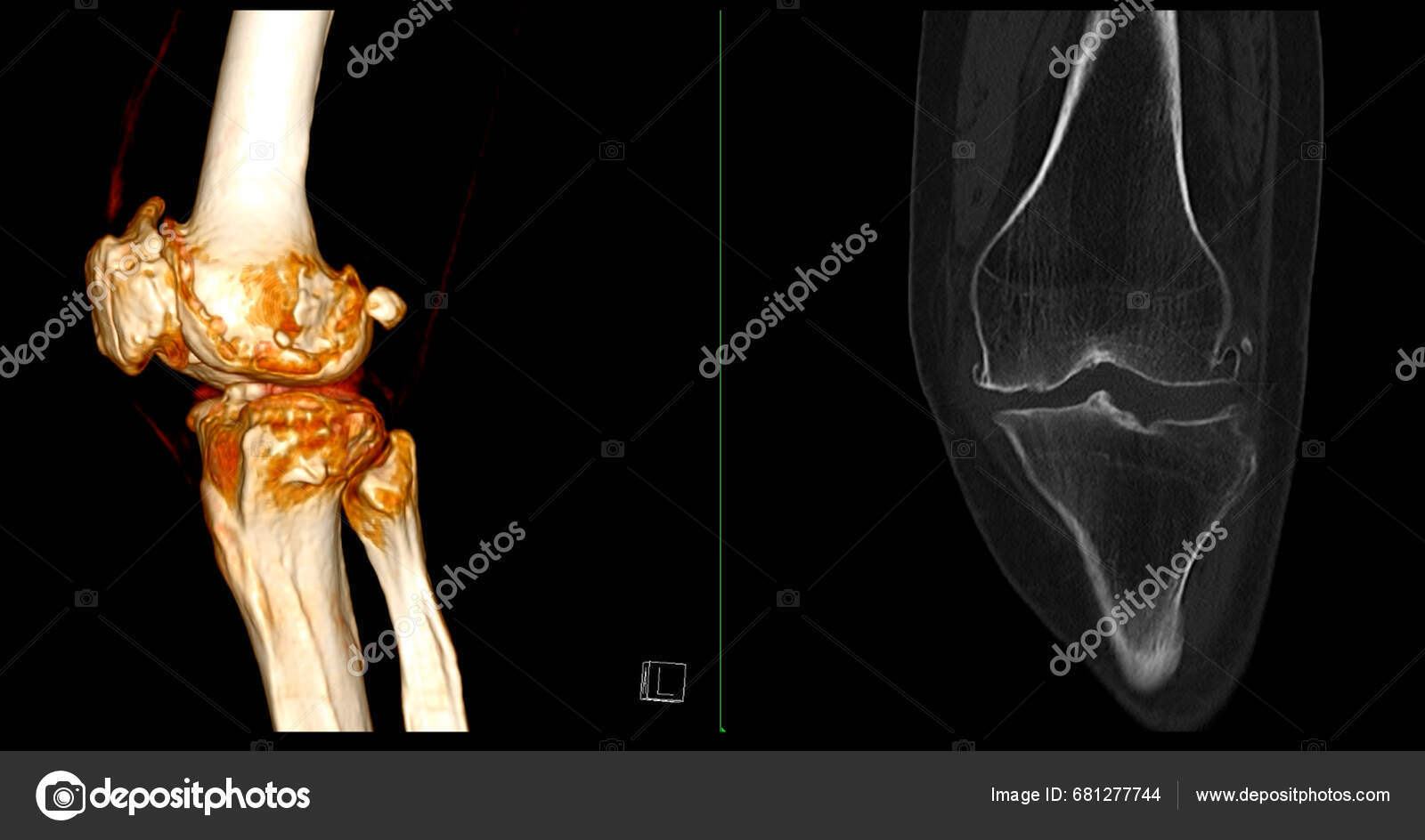 Scan Knee Joint Showing Fracture Tibia Fibula Bone Rendering — Foto ...