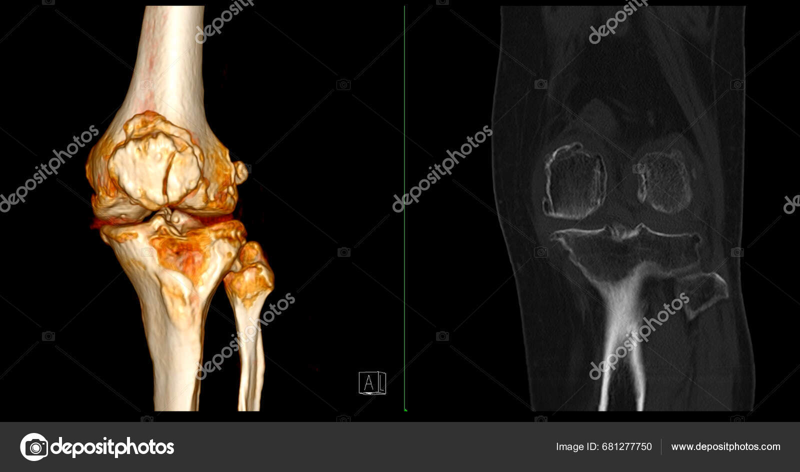 Scan Knee Joint Showing Fracture Tibia Fibula Bone Rendering Stock ...