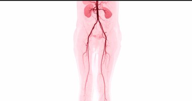 Kronik Akut veya Kronik Periferik Arter Hastalığı teşhisi için femoral arterin görüntüsü alınamıyor..