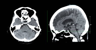 Beyin tümörü, felç ve damar hastalıkları için beyin sagital görüşünün CT taraması.