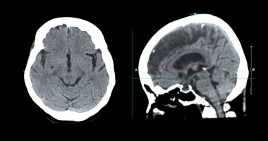 Beyin tümörü, felç ve damar hastalıkları için beyin sagital görüşünün CT taraması.