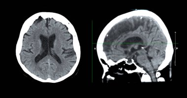 Beyin tümörü, felç ve damar hastalıkları için beyin sagital görüşünün CT taraması.
