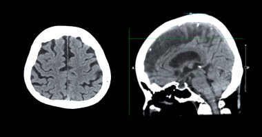 Beyin tümörü, felç ve damar hastalıkları için beyin sagital görüşünün CT taraması.