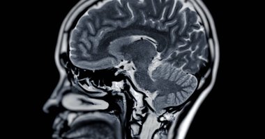 Beyin hastalıklarını tespit etmek için MR taraması. Felç, beyin tümörleri ve enfeksiyonlar gibi..