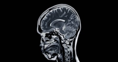 Beyin hastalıklarını tespit etmek için MR taraması. Felç, beyin tümörleri ve enfeksiyonlar gibi..