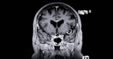 Beyin hastalıklarını tespit etmek için MR taraması. Felç, beyin tümörleri ve enfeksiyonlar gibi..