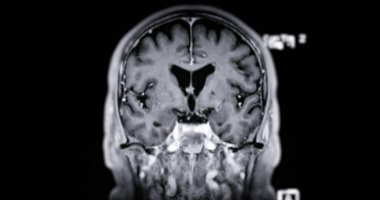 Beyin hastalıklarını tespit etmek için MR taraması. Felç, beyin tümörleri ve enfeksiyonlar gibi..