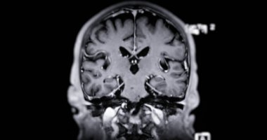 Beyin hastalıklarını tespit etmek için MR taraması. Felç, beyin tümörleri ve enfeksiyonlar gibi..