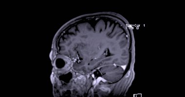 Beyin hastalıklarını tespit etmek için MR taraması. Felç, beyin tümörleri ve enfeksiyonlar gibi..